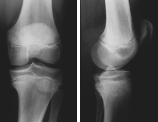 blount disease