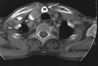 episternal ossicle