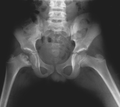 legg calve perthes disease