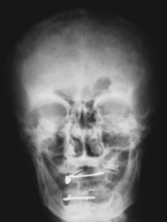 paget's disease