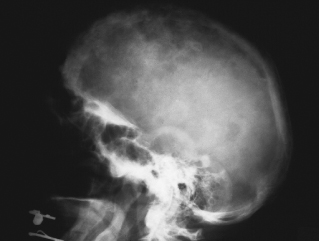 paget's disease