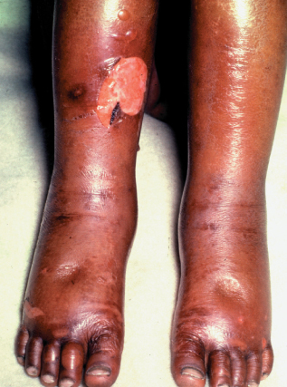 dermatosis of kwashiorkor