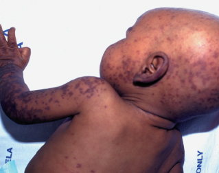 henoch-schonlein purpura