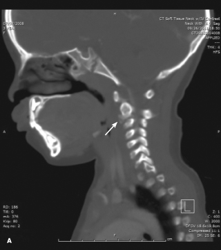 Idiopathic Intervertebral Disk Calcification