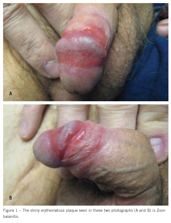 zoon balanitis