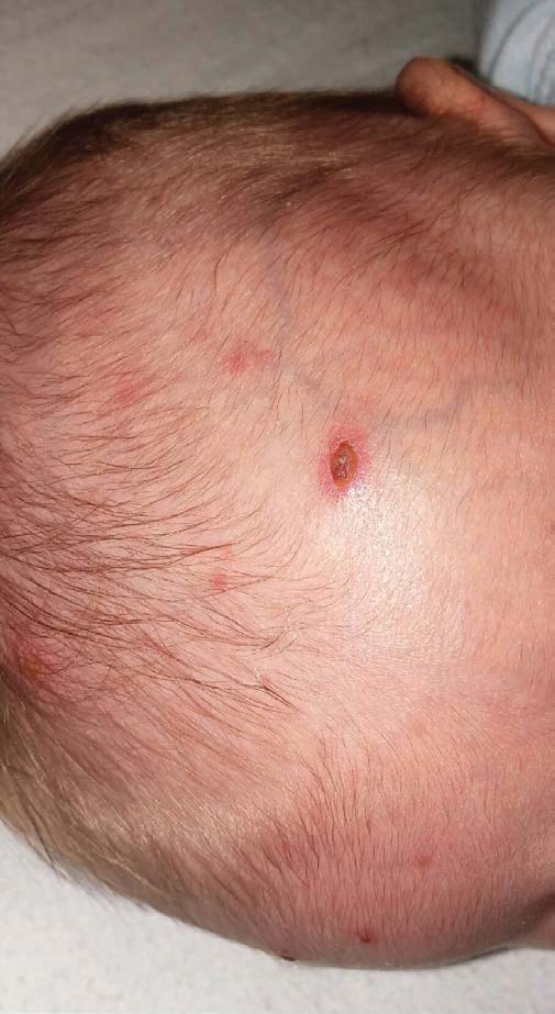 A Neonate with a Widespread and Worsening Vesicular Rash Consultant360