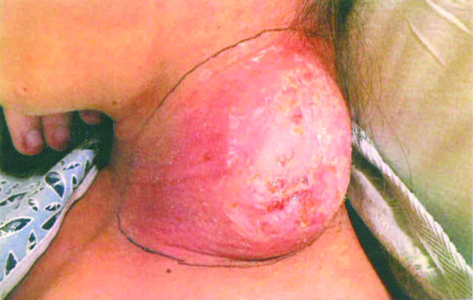 Homeless Teenager With a Painful and Growing Neck Mass