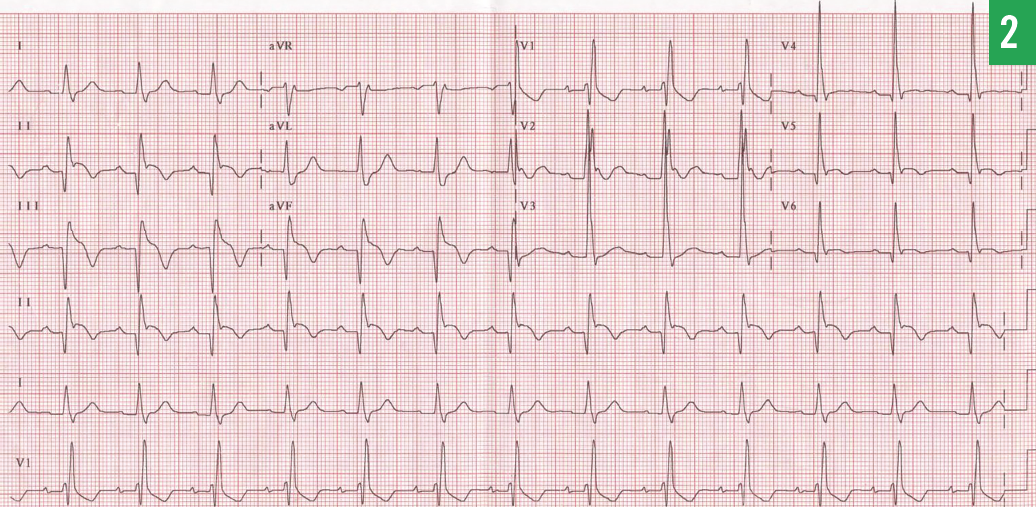 electrocardiogram (ECG)