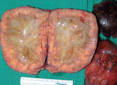 Epigastric Mass