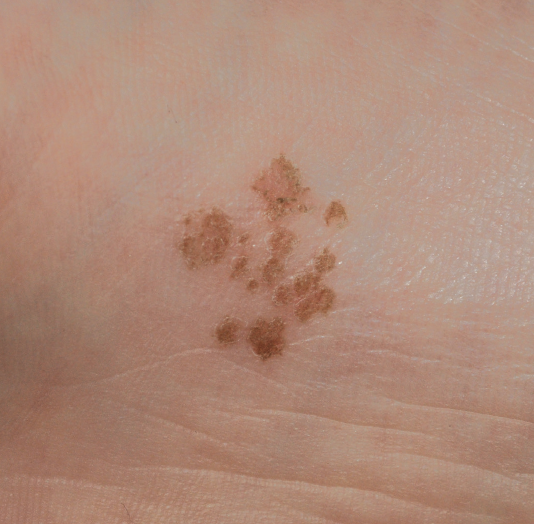 pigmented lesion