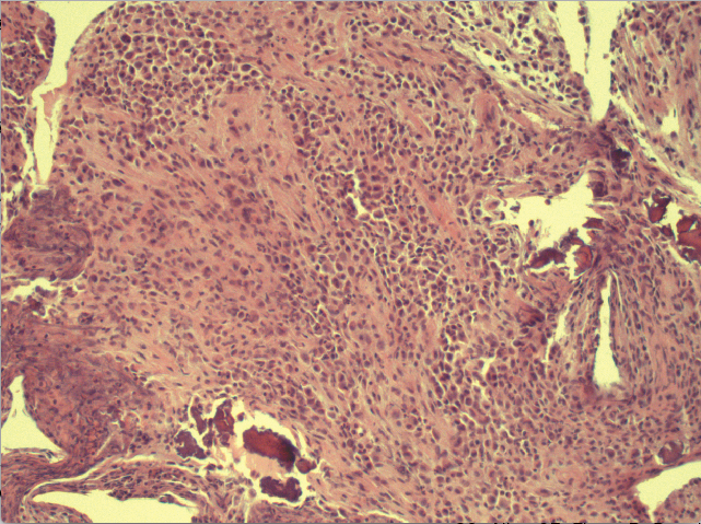 Pathology test results showed that sheets of polygonal cells had invaded and replaced numerous areas of the cranial bones. Minute fragments of surviving bone are present (arrow).