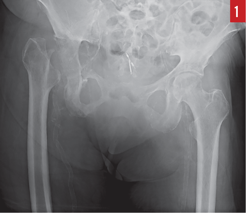 anteroposterior radiograph of pelvis