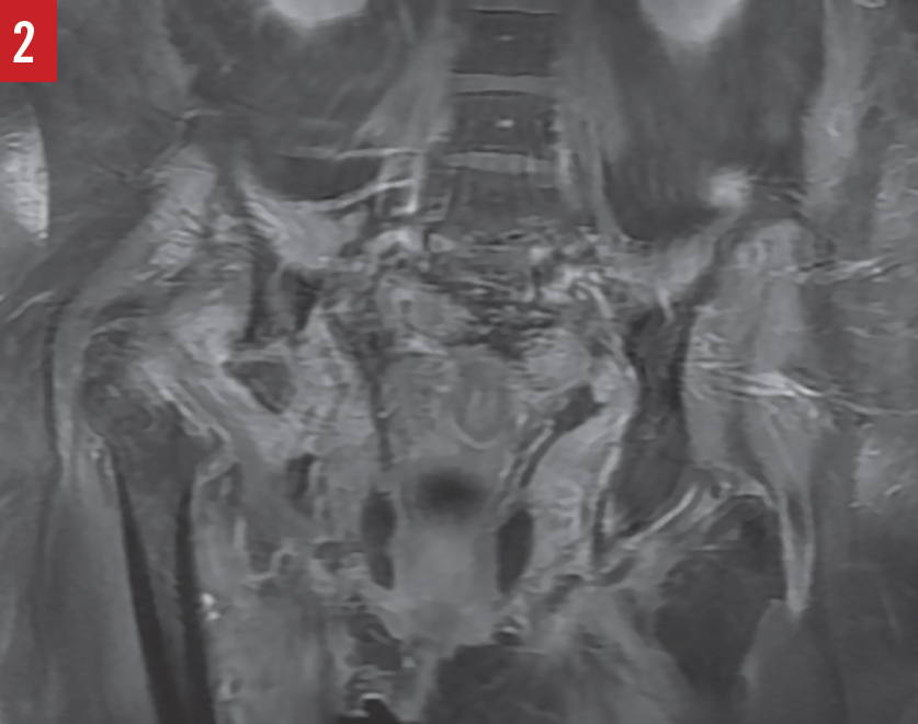 A Deeper Look at a Woman’s Persistent Hip Pain Uncovers a Case of