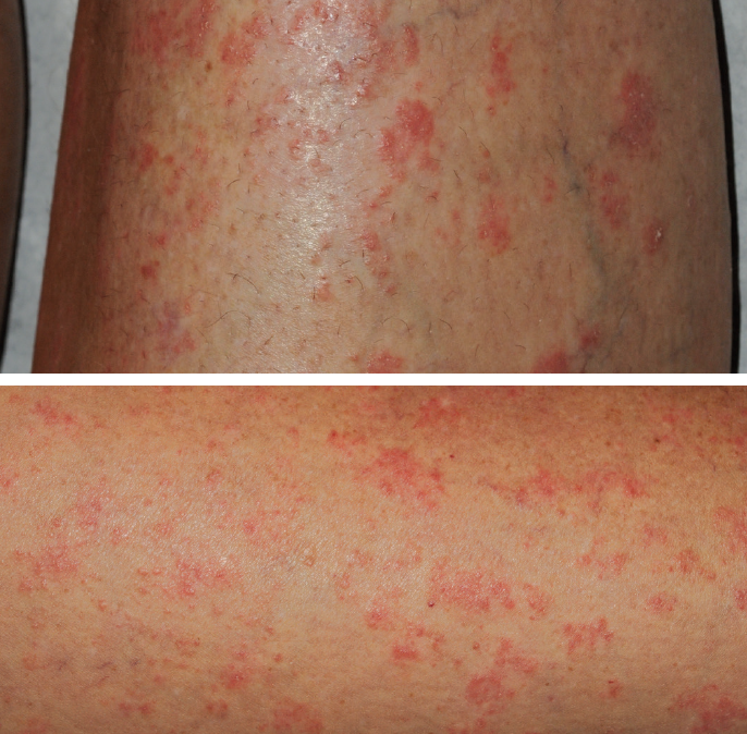 What is the cause of this patient’s psoriasis flare? Consultant360