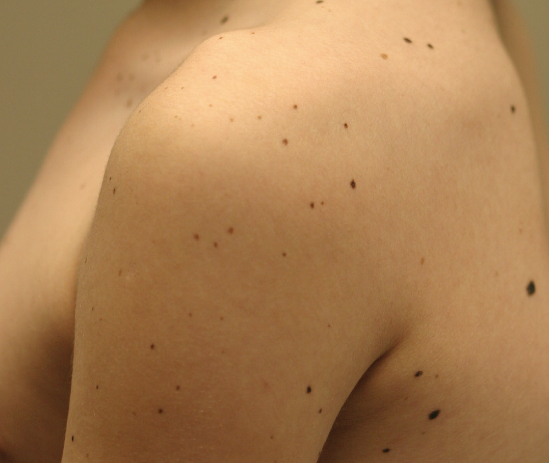 Leopard Syndrome Progressively Increasing Pigmented Macules In An 8 Year Old Boy Consultant360