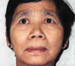 Pterygium