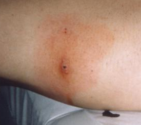 erythema migrans