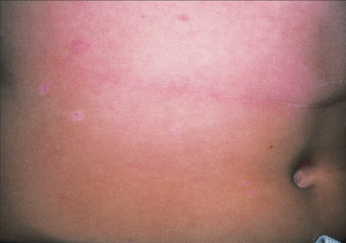 Pityriasis rosea