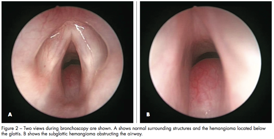 bronchoscopy