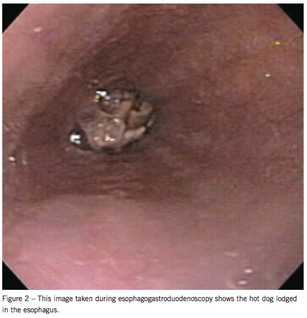 esophagogastroduodenoscopy