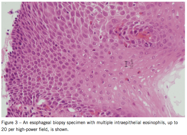 esophageal biopsy