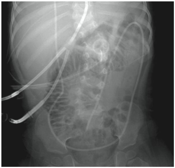 neutropenic enterocolitis