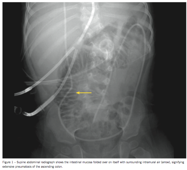 neurotropenic enterocolitis