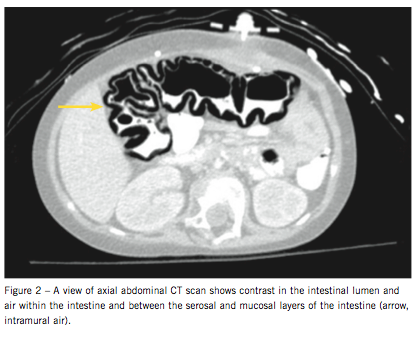 neurotropenic enterocolitis