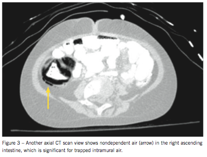 neurotropenic enterocolitis