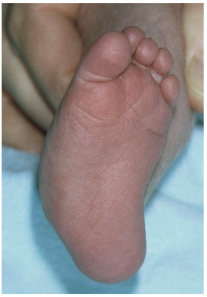 congenital vertical talus