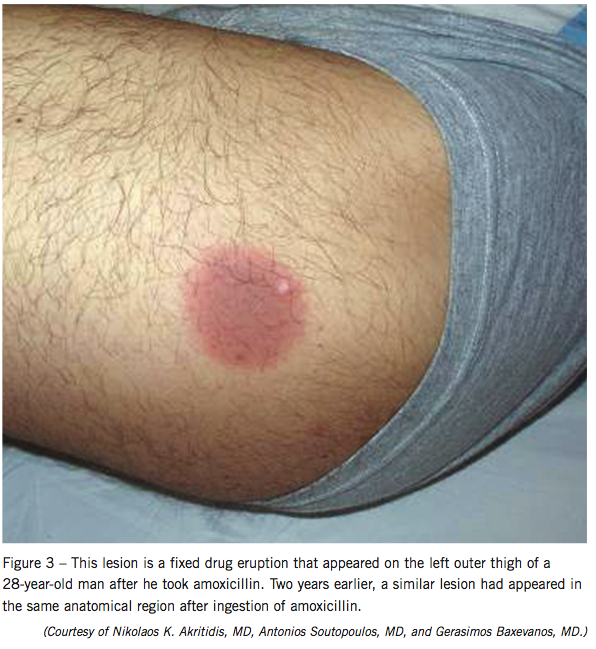 amoxicillin, reaction, eruption, lesion