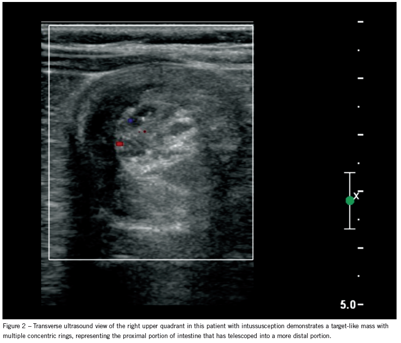 untrasound intussusception untrasound intussusception