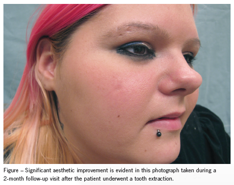 Cutaneous Sinus of Dental Origin