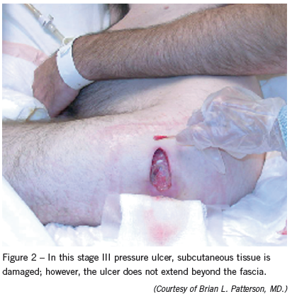 stage 3 pressure ulcer