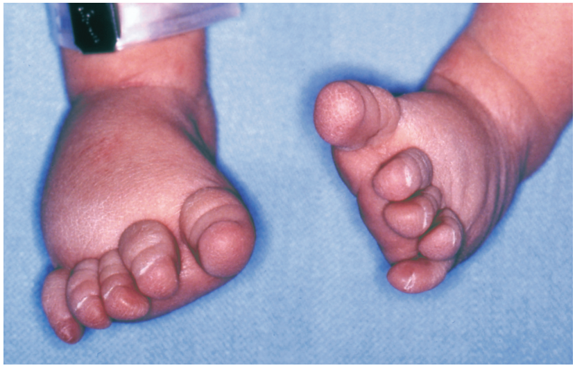 Milroy Disease