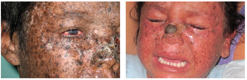Xeroderma pigmentosum