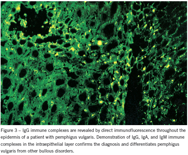 pemphigus vulgaris