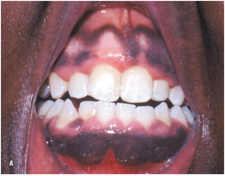 hyperpigmentation