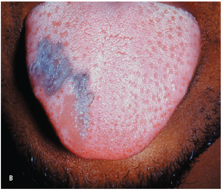 hyperpigmentation