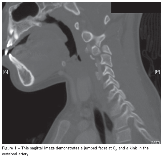 vertebral artery