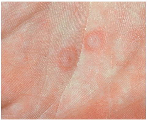erythema multiforme