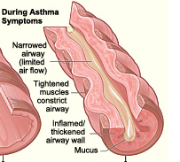 asthma symptoms