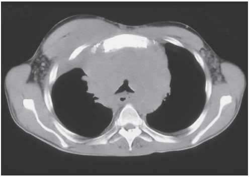 thorax mediastinal mass