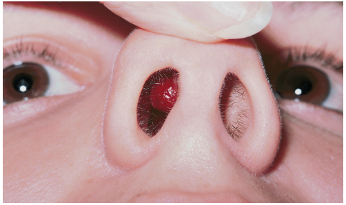 nasal hemangioma