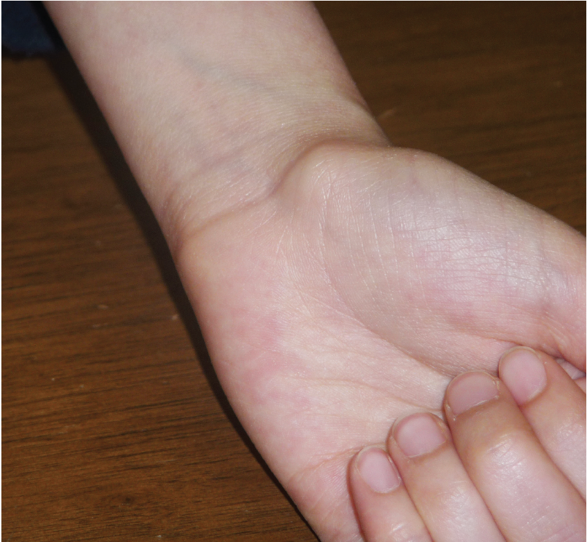 ganglion
