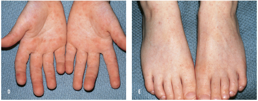 hand foot mouth