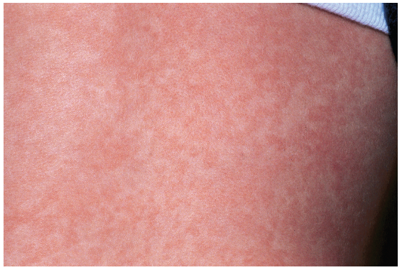 roseola infantum