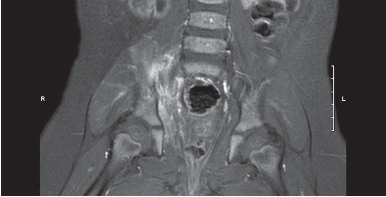 sacroiliitis