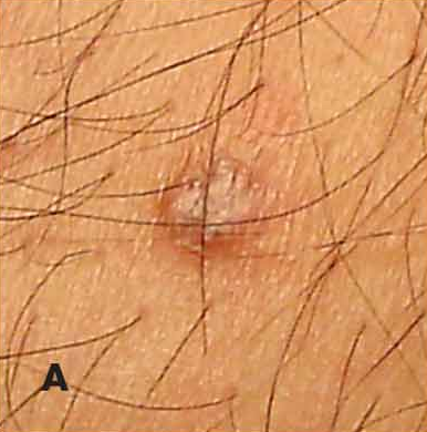 squamous cell carcinoma