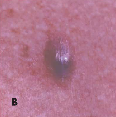 squamous cell carcinoma